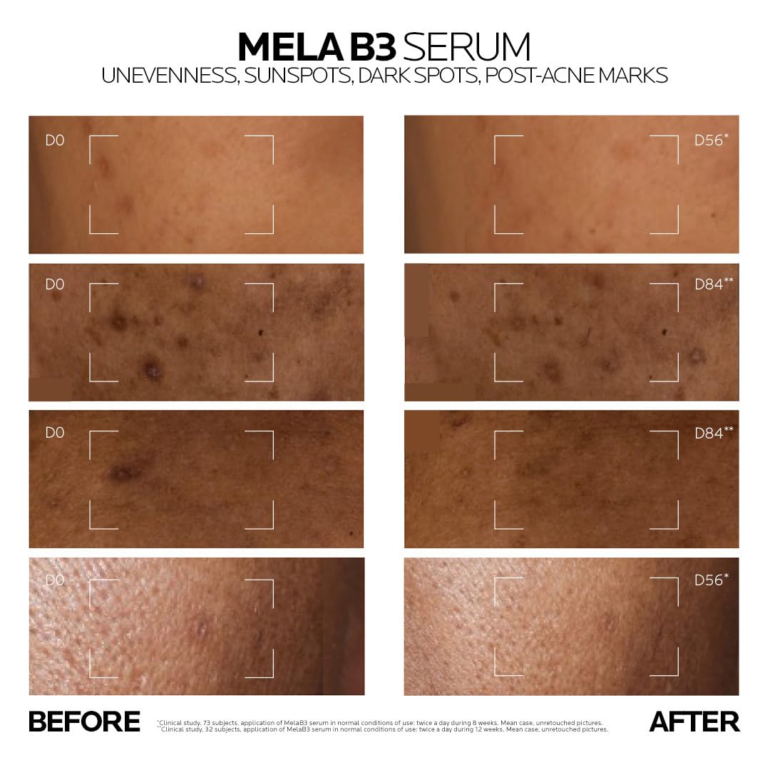 Before and after effects of Mela B3 Serum on skin with unevenness, sunspots, dark spots, and post-acne marks.
