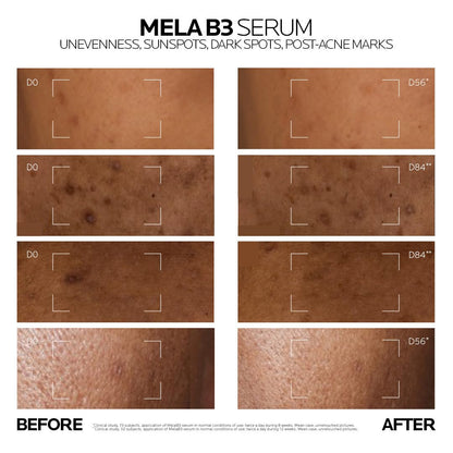Before and after effects of Mela B3 Serum on skin with unevenness, sunspots, dark spots, and post-acne marks.