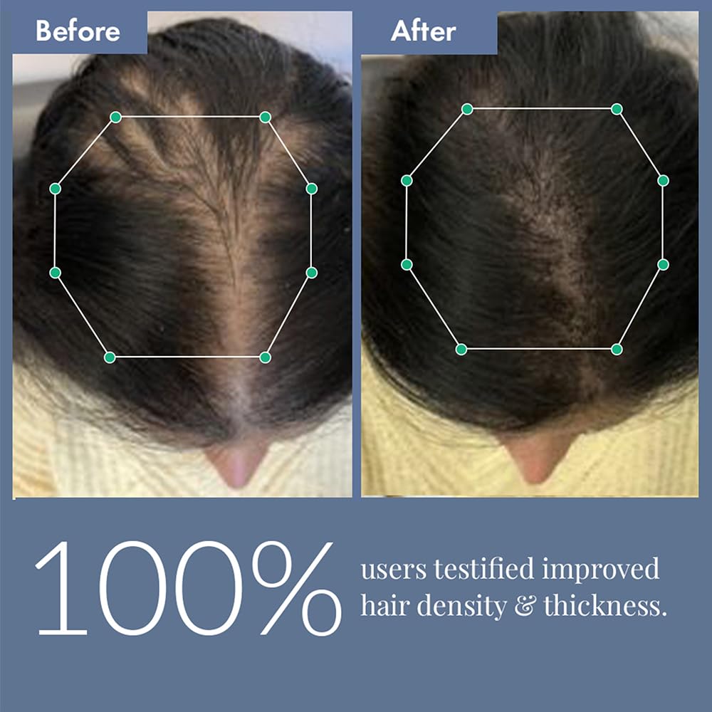 Before and after comparison of hair density and thickness with geometric measurements.