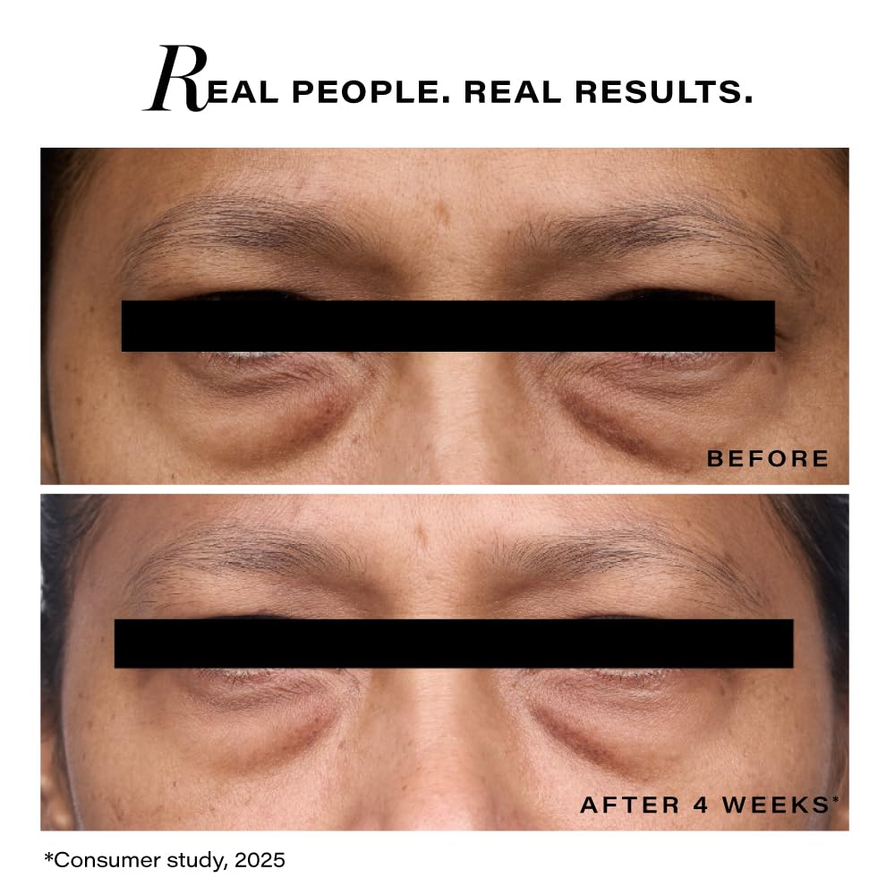 Before and after comparison of eye area treatment with text 'Real People. Real Results.'