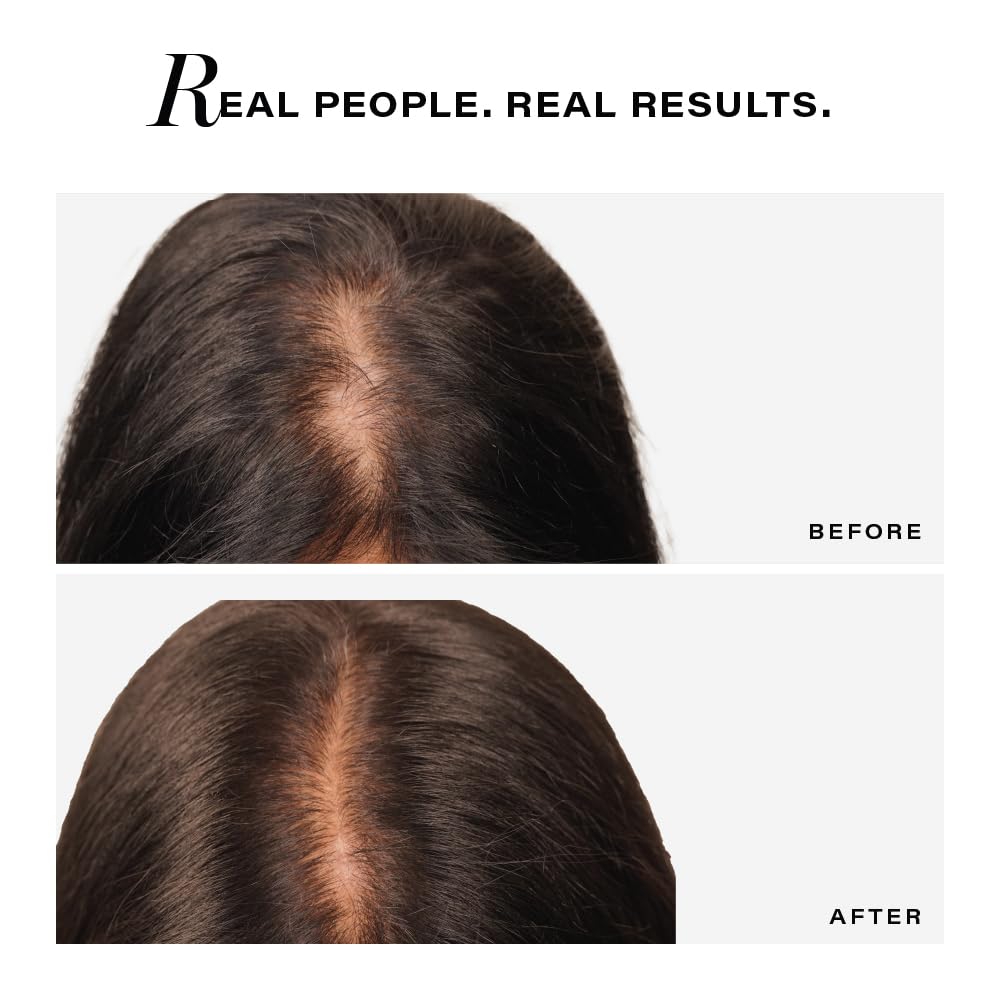 Before and after comparison of hair growth on a person's head.