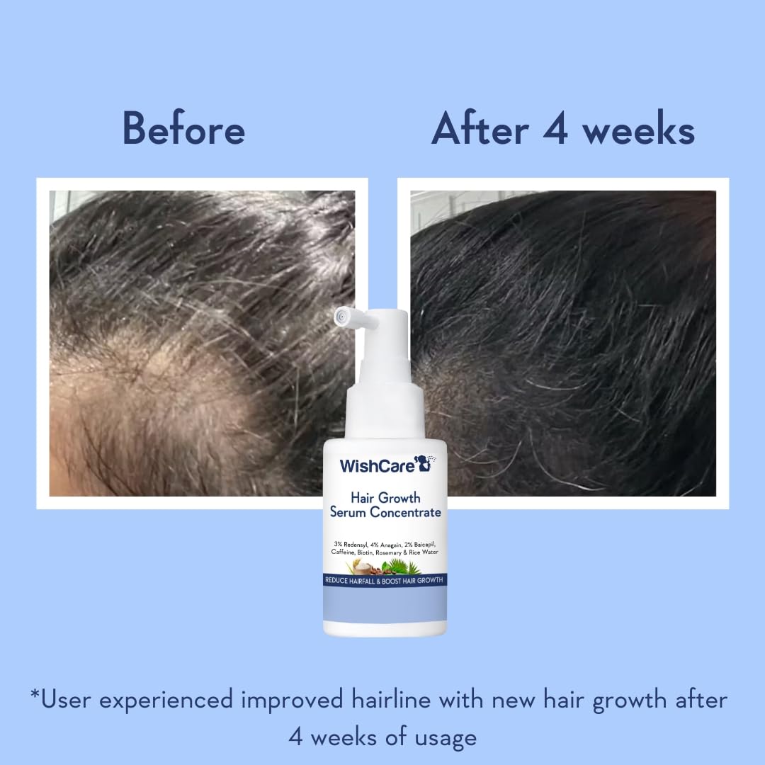 WishCare Hair Growth Serum + Anti Hair Fall Shampoo Combo for Men & Women | Redensyl, Anagain, Baicapil & Biotin | Reduces Hair Fall, Promotes Visible Hair Regrowth | Sulphate Free Shampoo + Leave-In Serum
