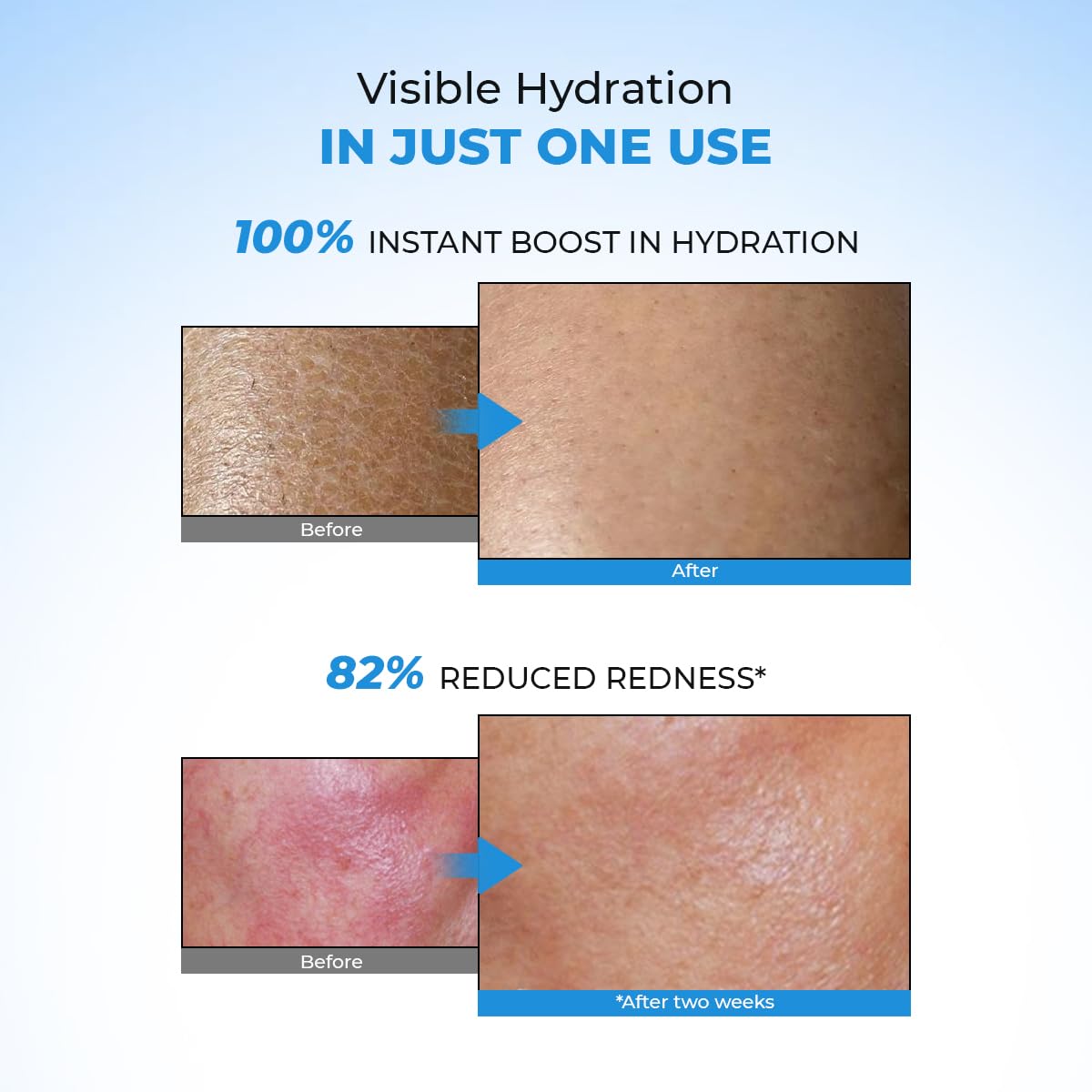 Before and after effects of a skincare product on skin hydration and redness.