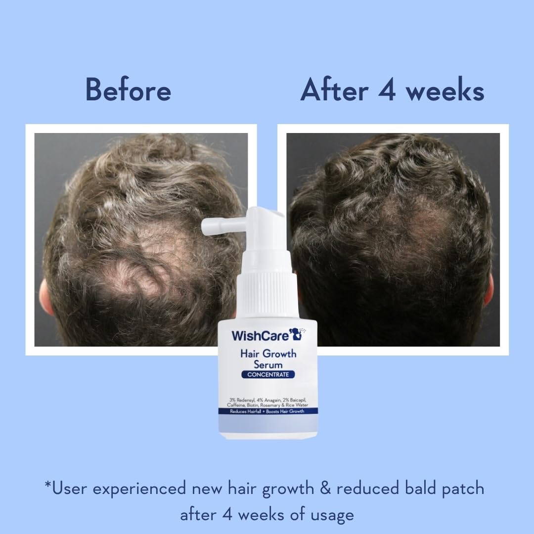 Before and after comparison of hair growth with WishCare Hair Growth Serum on a blue background.