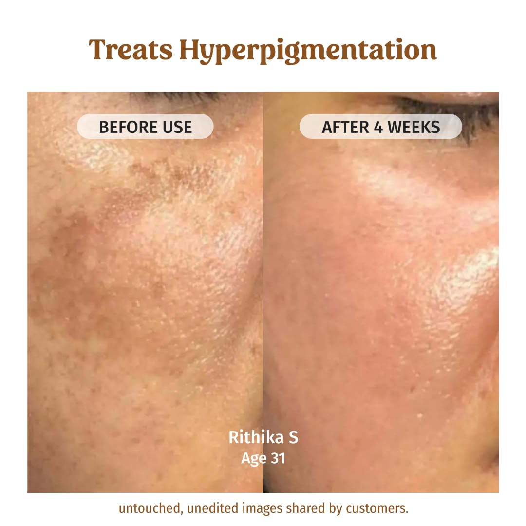 Vilvah Milk Drops Brightening Serum | Fades Dark Spots, Treats Hyperpigmentation & Evens Skin Tone | Hyaluronic Acid & Alpha Arbutin Serum for Women & Men | Suitable for All Skin Types | 20ml