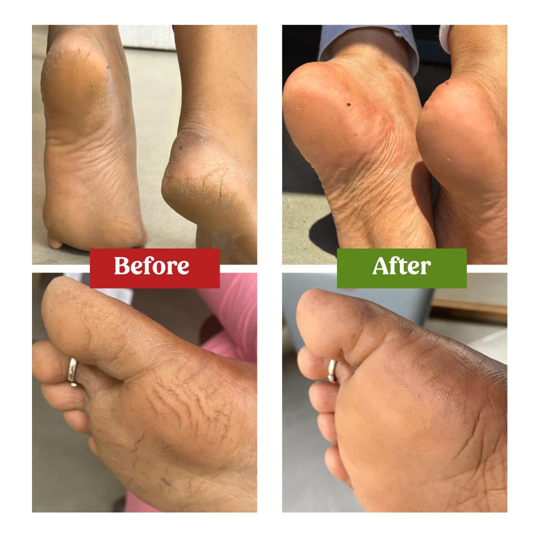 Vilvah Foot Cream for Cracked Heels | Repairs Dry, Rough & Damaged Feet | Softens Calluses & Removes Dead Skin | Deep Hydration & Odour Control | 100ml
