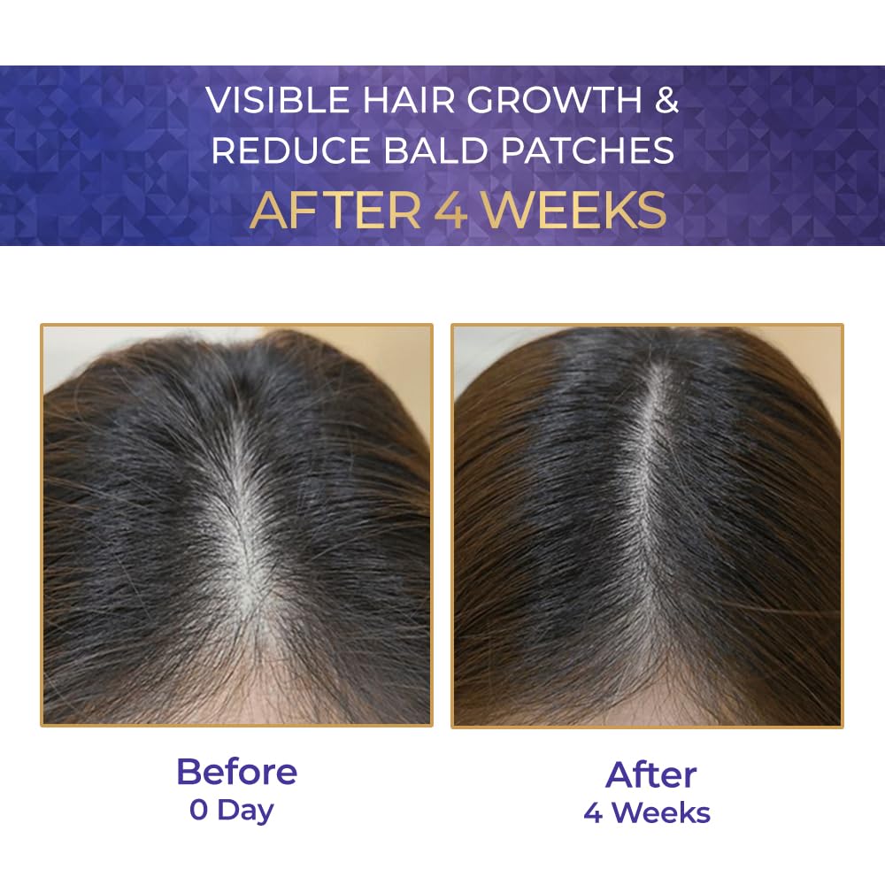 Before and after comparison of hair growth treatment showing visible hair growth and reduced bald patches after 4 weeks.