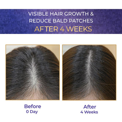 Before and after comparison of hair growth treatment showing visible hair growth and reduced bald patches after 4 weeks.