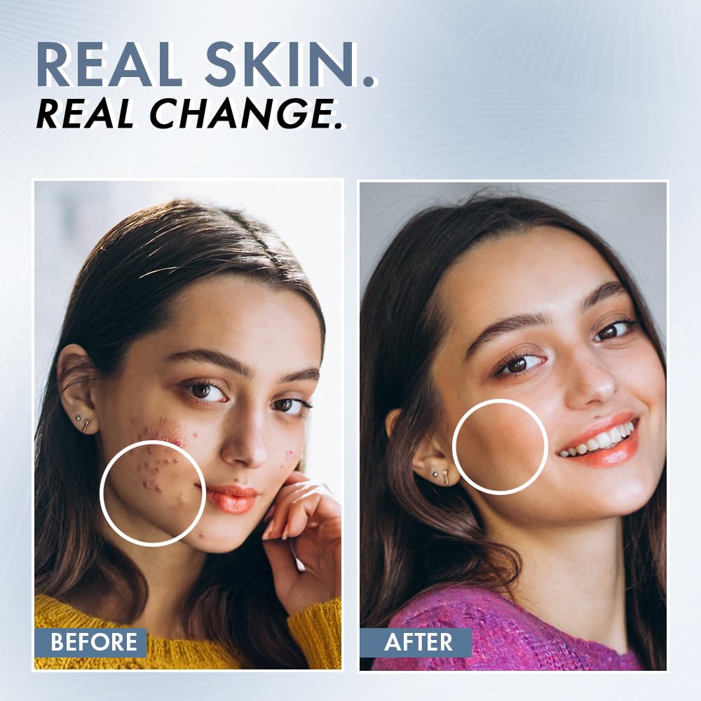 Before and after comparison of a woman's face with visible skin improvement.