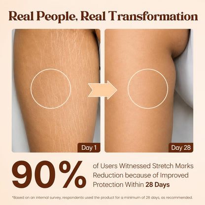 Pokonut Stretch Marks Cream for Women & Men | For Pregnancy, After Delivery & Weight Loss | Fades Old & New Marks on Belly, Thighs & Hips | Hyaluronic Acid + Rosehip Oil | Non-Sticky | 50g