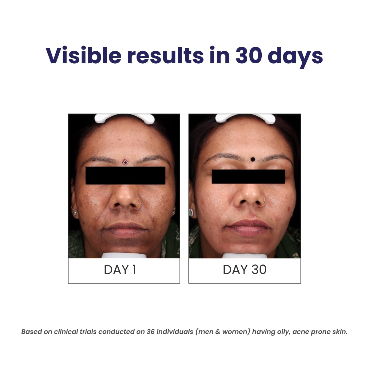 Before and after comparison of skin condition on a person with text indicating visible results in 30 days.