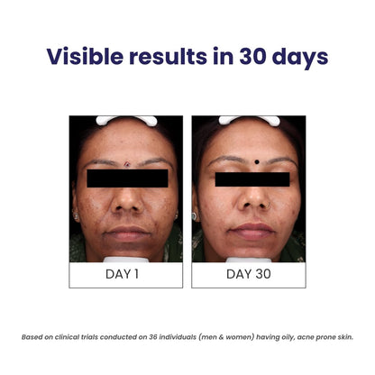 Before and after comparison of skin condition on a person with text indicating visible results in 30 days.