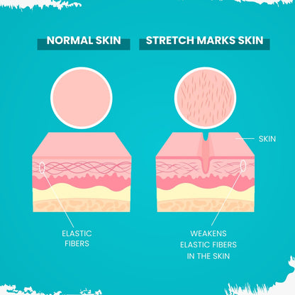Diagram comparing normal skin and stretch marks skin with labeled elastic fibers.