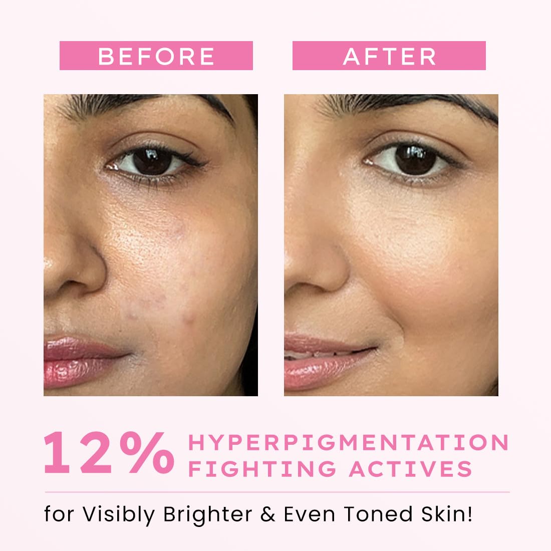 Before and after comparison of skin with hyperpigmentation treatment showing visibly brighter and even toned skin.