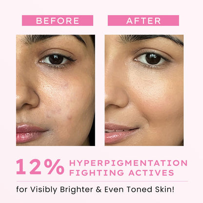 Before and after comparison of skin with hyperpigmentation treatment showing visibly brighter and even toned skin.