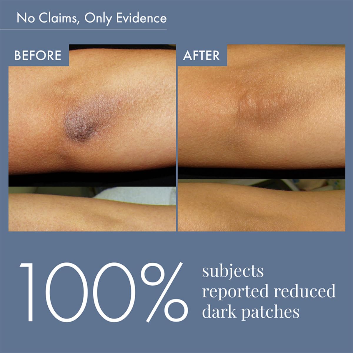Before and after comparison of dark patches on skin with text indicating 100% success rate.