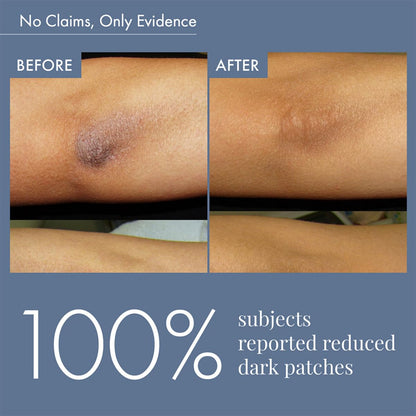 Before and after comparison of dark patches on skin with text indicating 100% success rate.