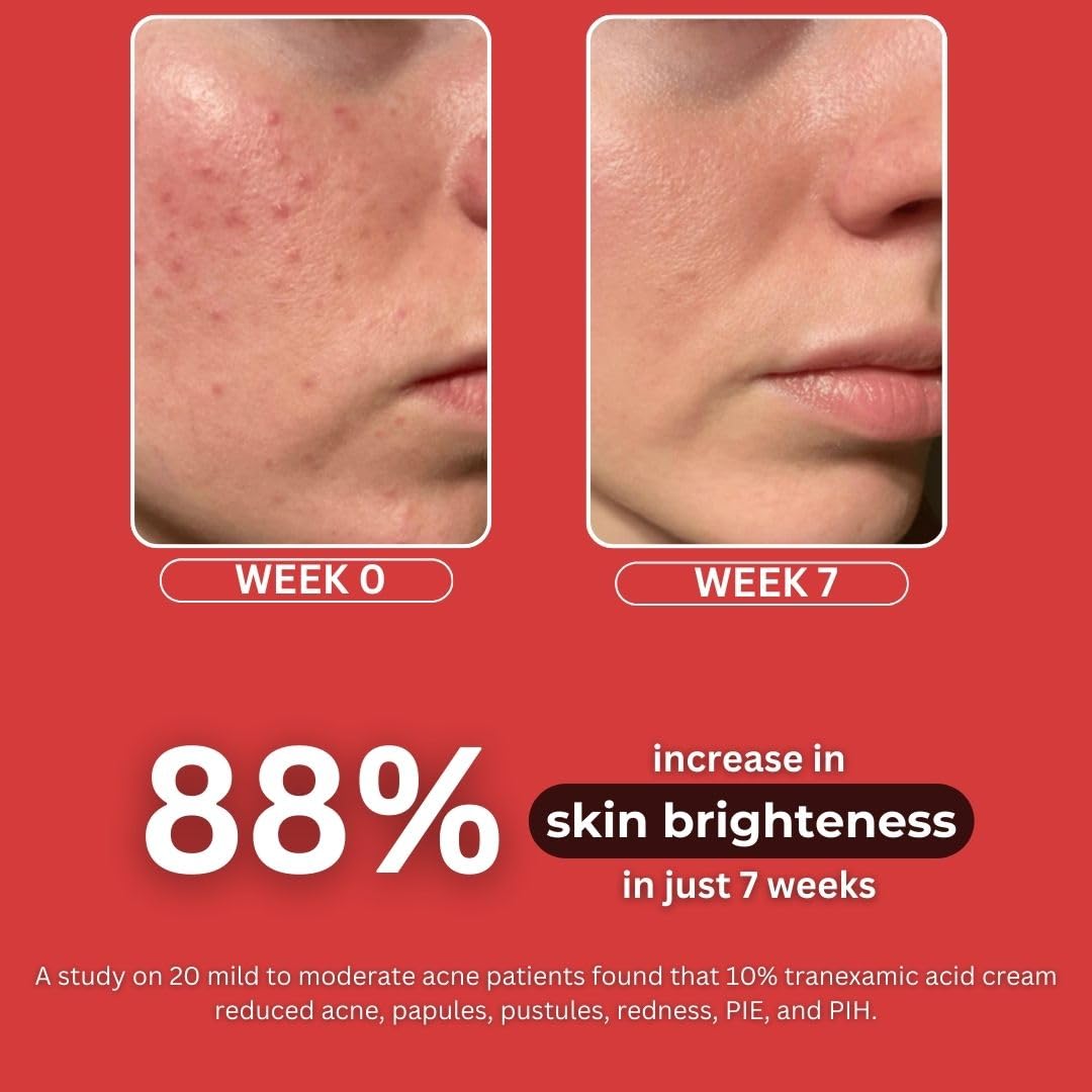 BLUSHLIN 10% Tranexamic Acid Cream with 2% Kojic Acid + 5% Vitamin C + 1% Arbutin | Pigmentation Removal Face Cream | Helps Even Skin Tone, Reduce Dark Spots, Blemishes and Scars - 10gm