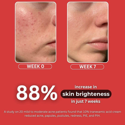 BLUSHLIN 10% Tranexamic Acid Cream with 2% Kojic Acid + 5% Vitamin C + 1% Arbutin | Pigmentation Removal Face Cream | Helps Even Skin Tone, Reduce Dark Spots, Blemishes and Scars - 10gm