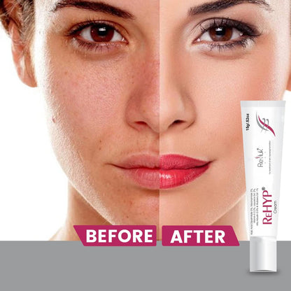 Rehyp Pigmentation Cream for Women – Dark Spot Remover, Brightening Face Cream with Kojic Acid & Alpha Arbutin – Paraben-Free, Dermatologically Tested – 15g