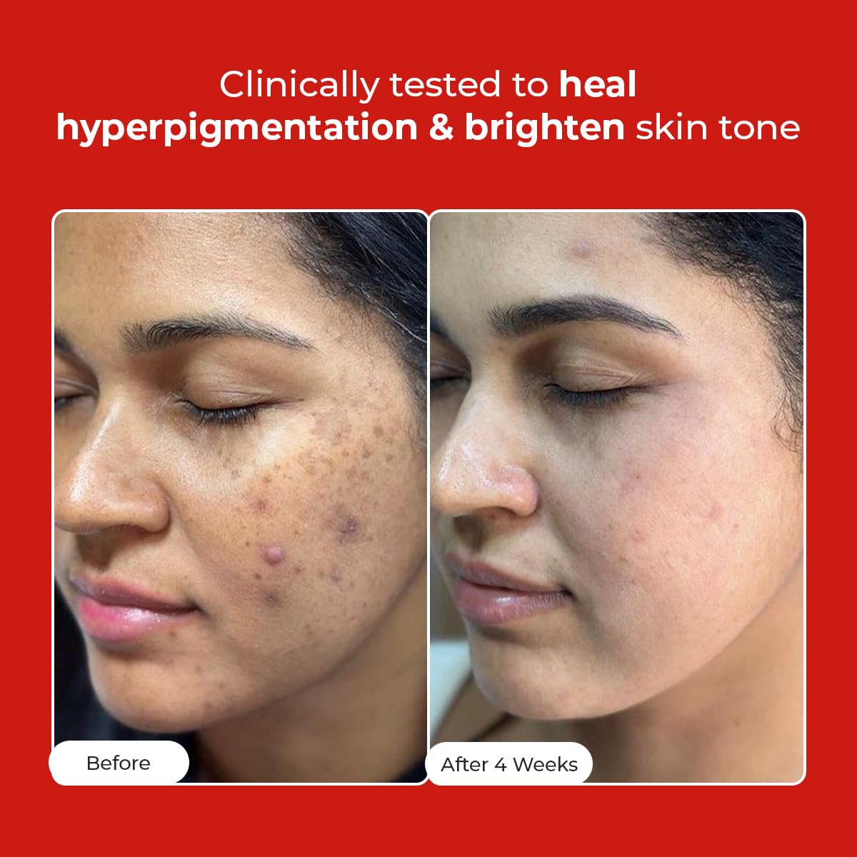 Before and after comparison of a woman's face with text indicating clinical testing for hyperpigmentation and skin tone improvement.