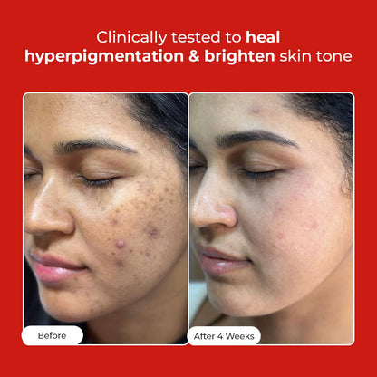 Before and after comparison of a woman's face with text indicating clinical testing for hyperpigmentation and skin tone improvement.