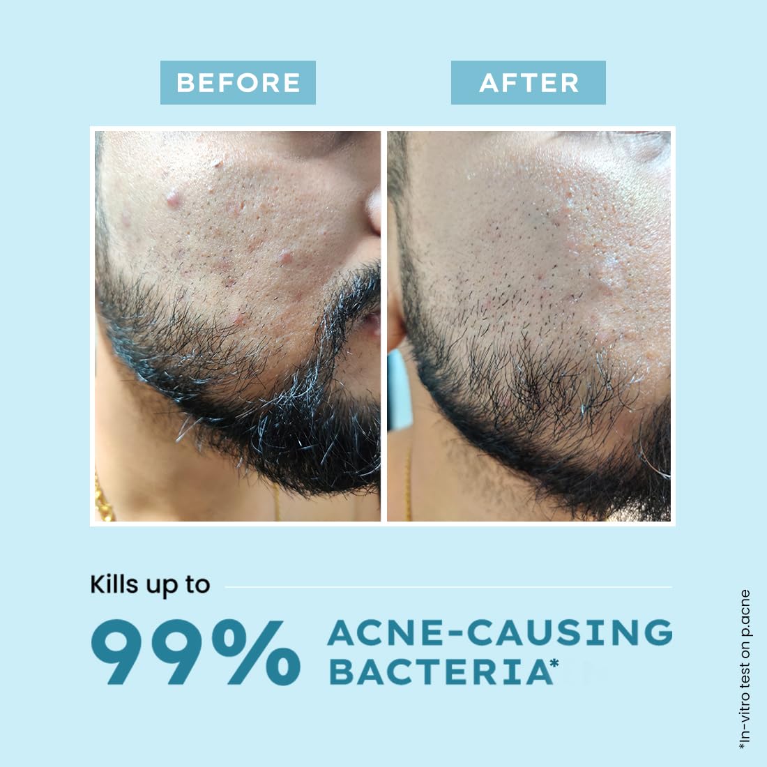 Before and after comparison of acne on a person's face with text about killing 99% of acne-causing bacteria.