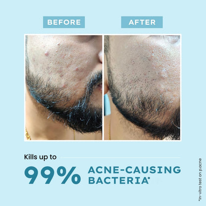 Before and after comparison of acne on a person's face with text about killing 99% of acne-causing bacteria.