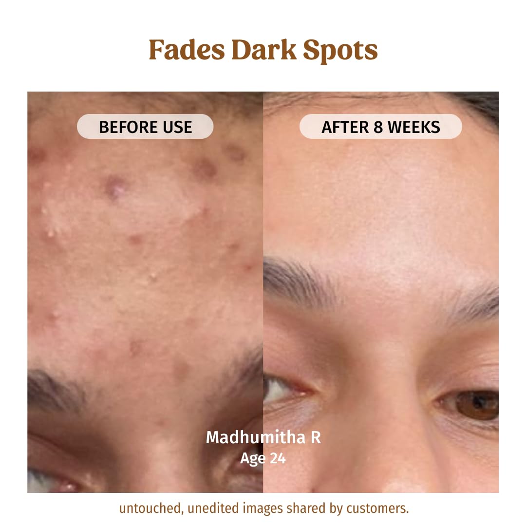 Vilvah Milk Drops Brightening Serum | Fades Dark Spots, Treats Hyperpigmentation & Evens Skin Tone | Hyaluronic Acid & Alpha Arbutin Serum for Women & Men | Suitable for All Skin Types | 20ml