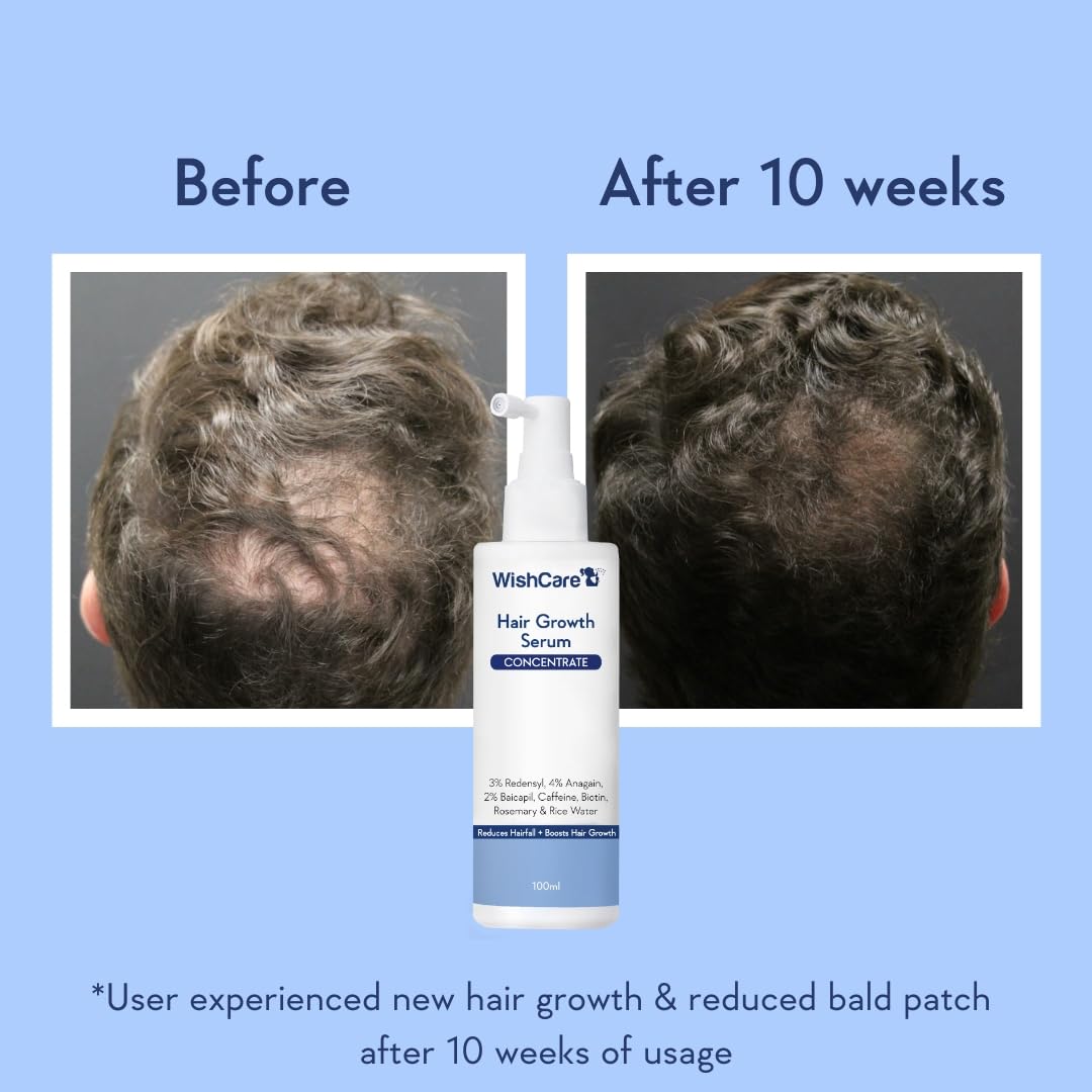 Before and after comparison of hair growth with WishCare Hair Growth Serum on a blue background.
