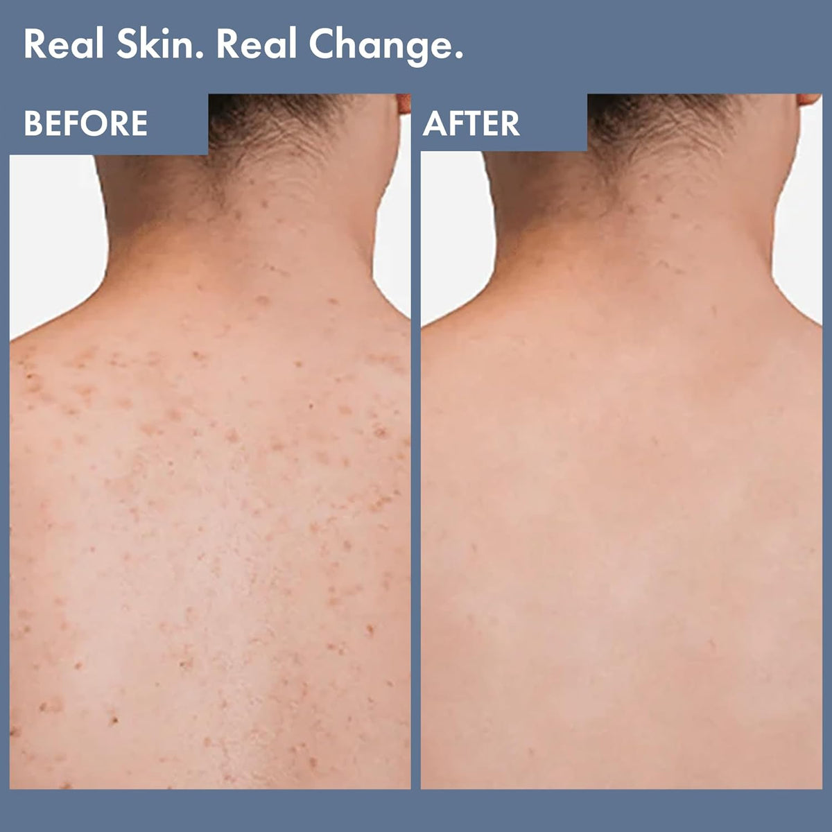 Before and after comparison of skin on a person's back with text 'Real Skin. Real Change.'