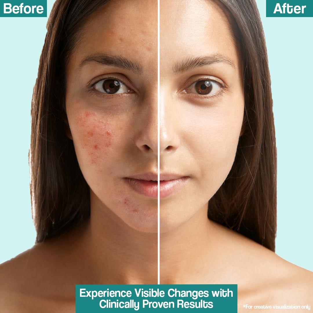 VENUSIA Dr. Reddy's Acne Control Moisturizer I For Oily & Acne Prone Skin I Prevents Acne Breakouts|Oil Free, Non Sticky I 75G