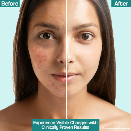 VENUSIA Dr. Reddy's Acne Control Moisturizer I For Oily & Acne Prone Skin I Prevents Acne Breakouts|Oil Free, Non Sticky I 75G