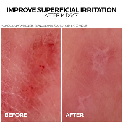 Before and after comparison of superficial irritation on skin with text indicating improvement after 14 days.