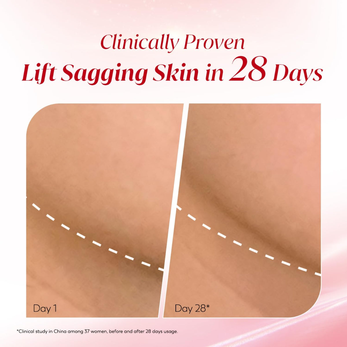 Before and after comparison of sagging skin treatment showing clinical results in 28 days.
