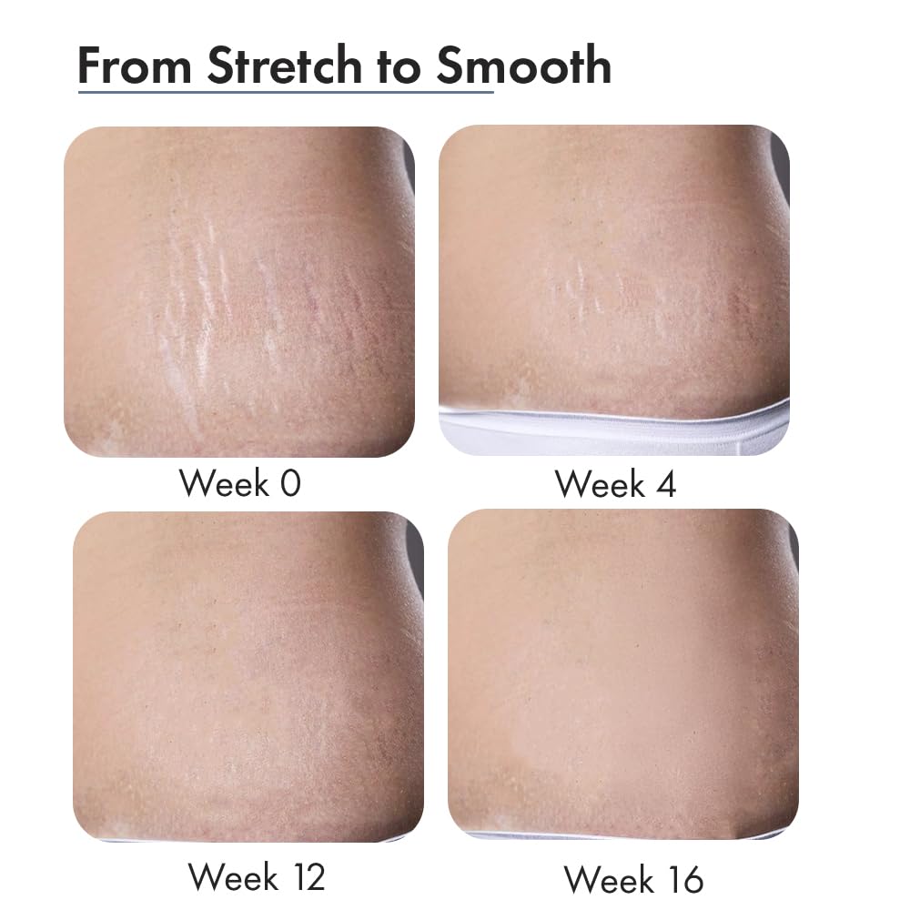 Before and after comparison of skin texture improvement over 16 weeks.