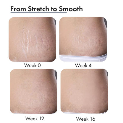 Before and after comparison of skin texture improvement over 16 weeks.