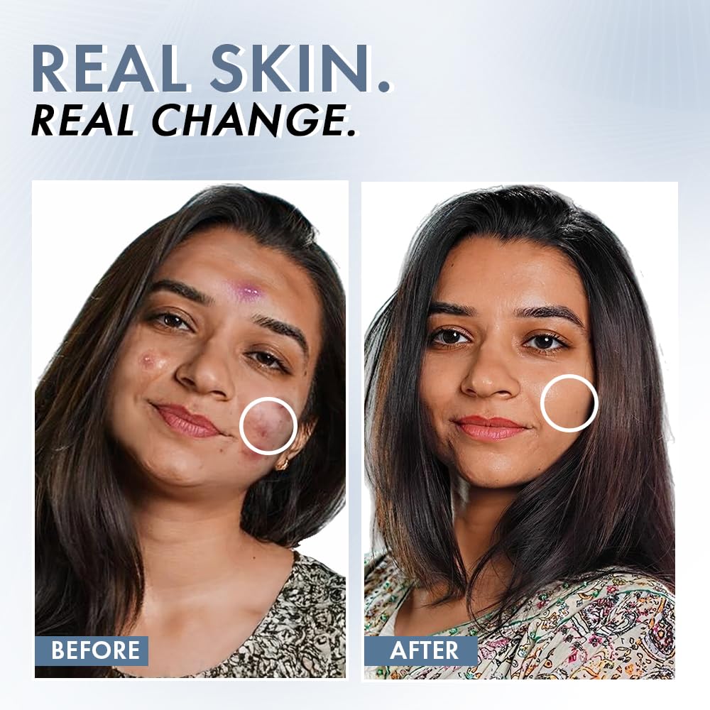 Before and after comparison of a woman's face with visible skin improvement.