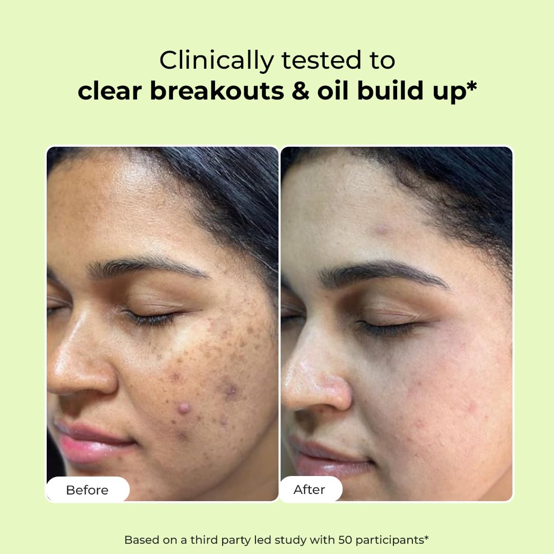 Before and after comparison of a person's face with acne on a green background.