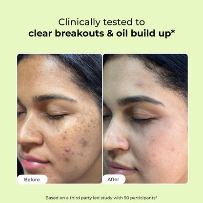 Before and after comparison of a person's face with acne on a green background.
