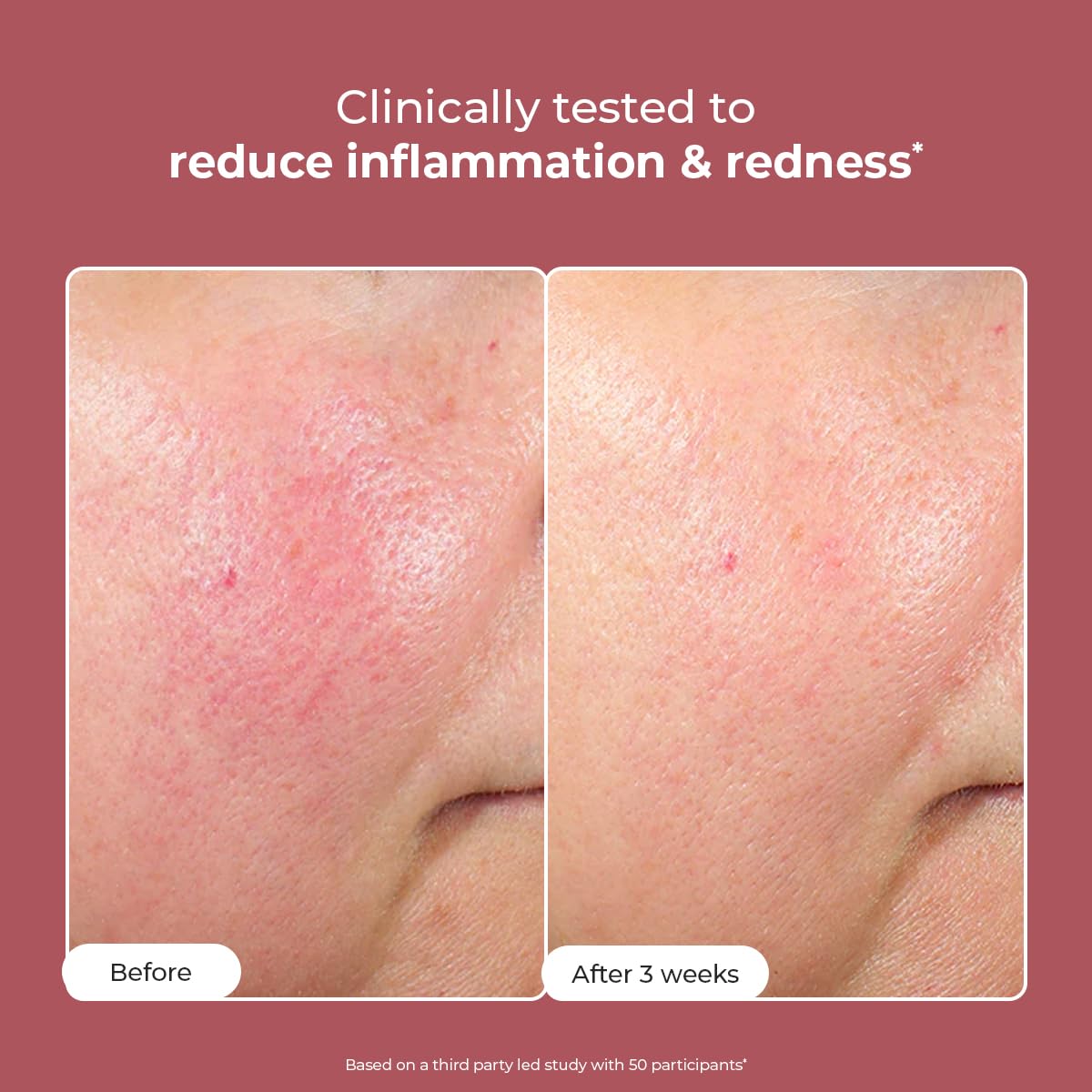 Conscious Chemist® Sunscreen & Azelaic Acid Cream Combo | SPF 50 PA++++ In-Vivo Tested | Sunscreen with Niacinamide & Blackberry | 10% Azelaic Acid Face Cream for Acne-Prone Skin, Redness Relief | All Skin Types - Berry Bright & Azicalm