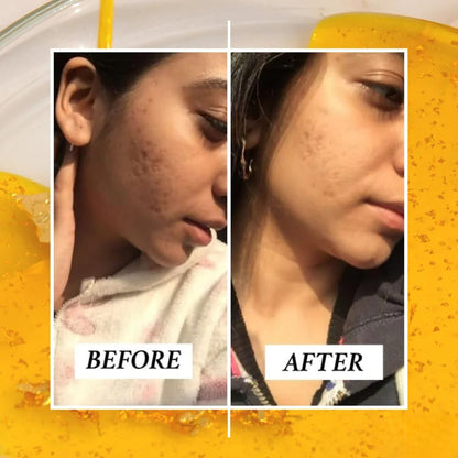 Before and after comparison of a person's face with visible skin improvement.