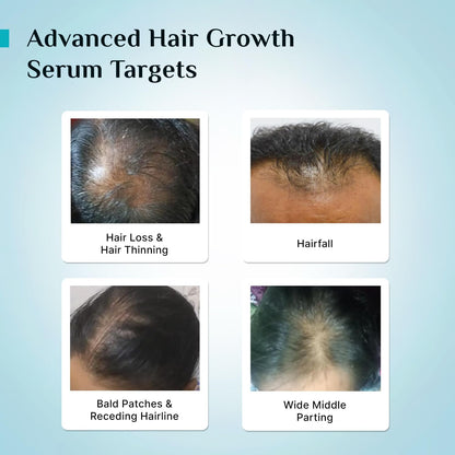 Pilgrim Redensyl 3% + Anagain 4% + 5% Capilia Stem Advanced Hair Growth Serum (30ml) for Scalp with Korean Black Rice & Rosemary | Control Hair Fall, Stimulate Hair Regrowth, Increase Hair Density