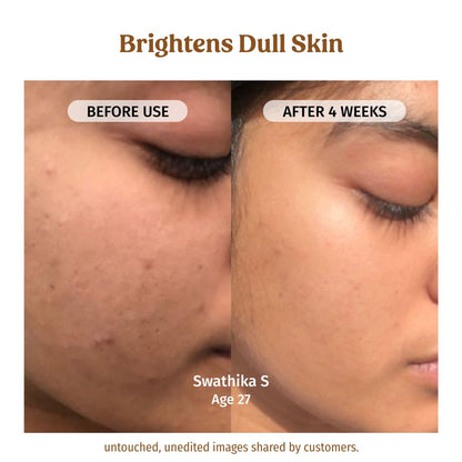 Vilvah Milk Drops Brightening Serum | Fades Dark Spots, Treats Hyperpigmentation & Evens Skin Tone | Hyaluronic Acid & Alpha Arbutin Serum for Women & Men | Suitable for All Skin Types | 20ml
