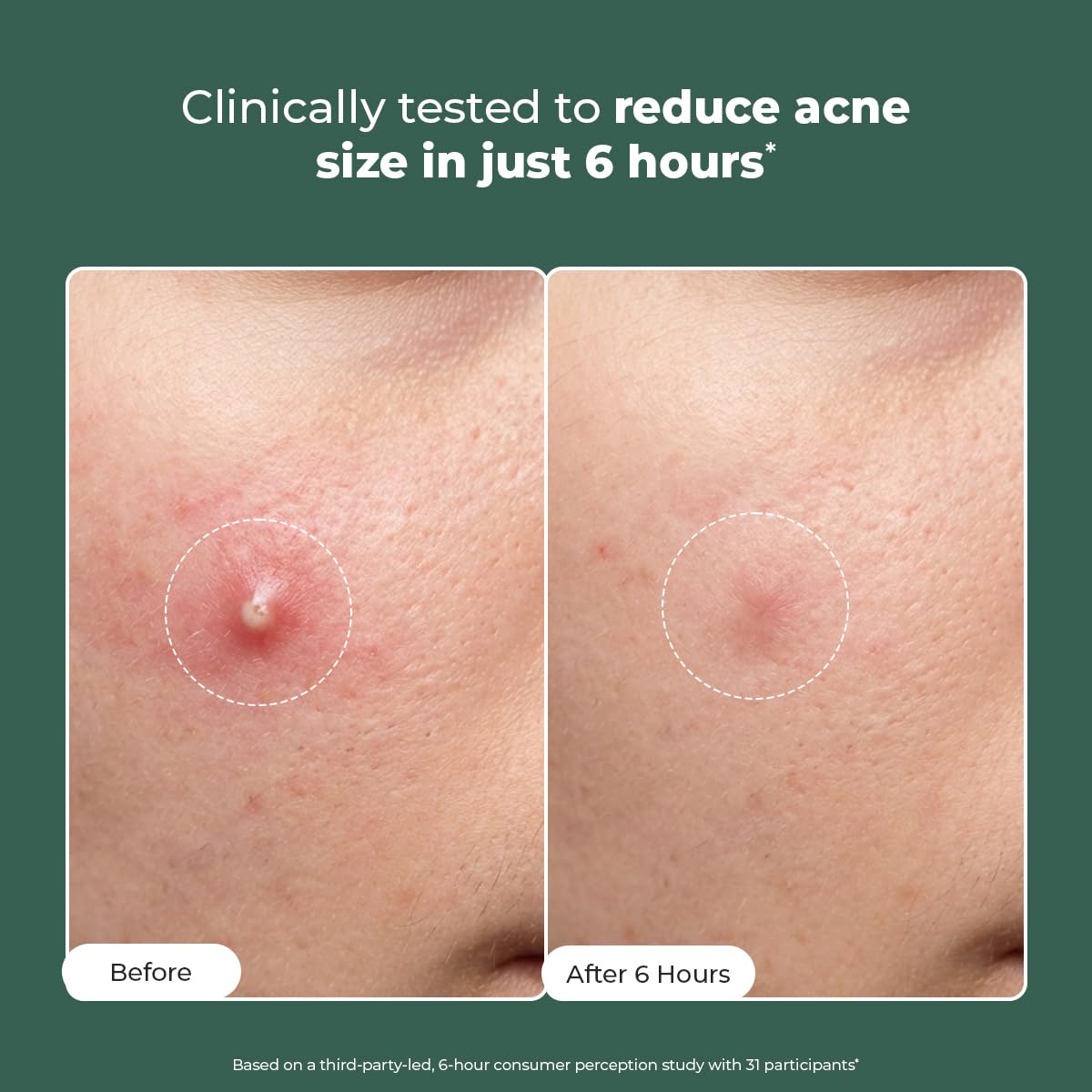 Before and after comparison of acne treatment showing reduced size in 6 hours.