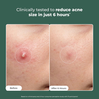 Before and after comparison of acne treatment showing reduced size in 6 hours.