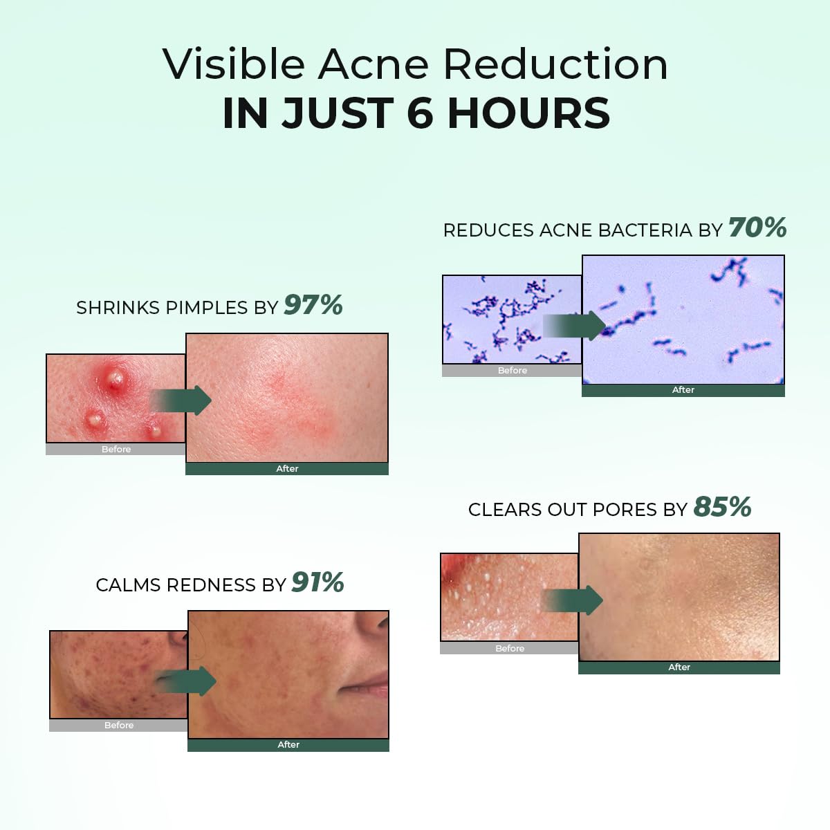 Acne reduction claims with before and after images on a light green background