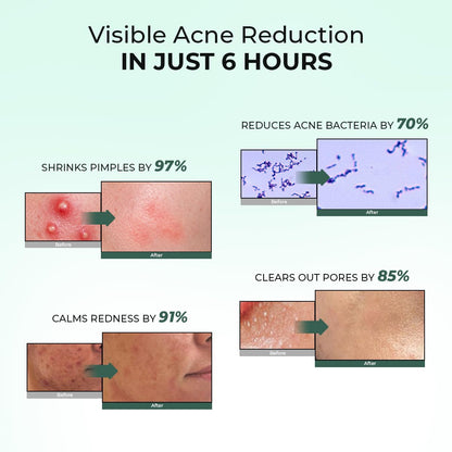Acne reduction claims with before and after images on a light green background