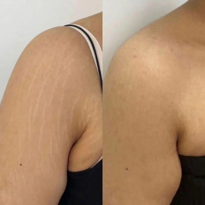 Pokonut Stretch Marks Cream for Women & Men | For Pregnancy, After Delivery & Weight Loss | Fades Old & New Marks on Belly, Thighs & Hips | Hyaluronic Acid + Rosehip Oil | Non-Sticky | 50g