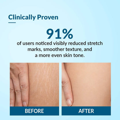 Before and after comparison of skin with stretch marks on a blue background, showing 91% improvement.